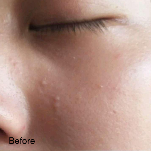 Don’t Let Acne Affect Your Beauty 5 1 副本1 1