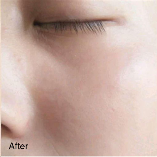 Don’t Let Acne Affect Your Beauty 11 1 副本2 1