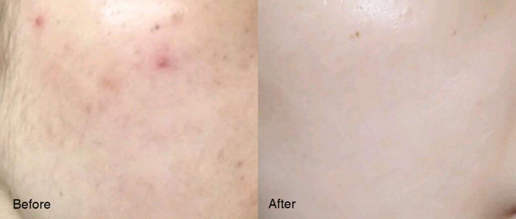 How Can I Save My Pitted Face? 1 2 22