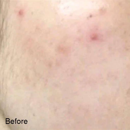 Don’t Let Acne Affect Your Beauty 3 2 副本1 1