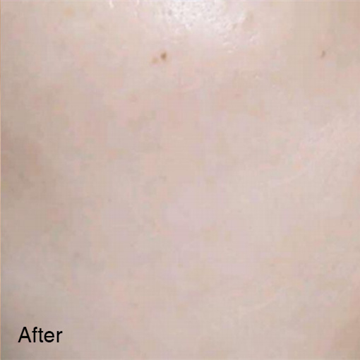 Don’t Let Acne Affect Your Beauty 9 2 副本2 1