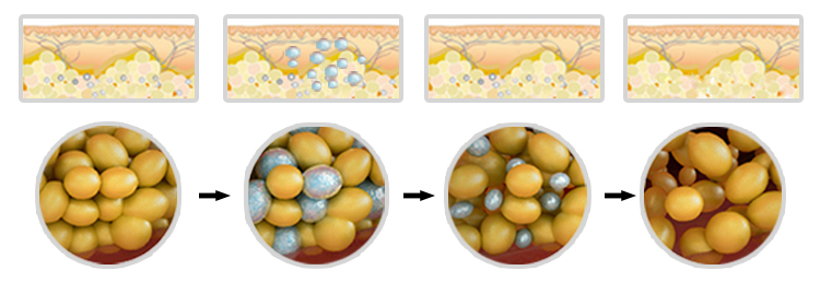 いつでもどこでも簡単ダイエット – ポータブル脂肪凍結 Cryolipolysis 痩身マシン 7 便携式脂肪冷冻去脂机 - Cryolipolysis 瘦身仪器