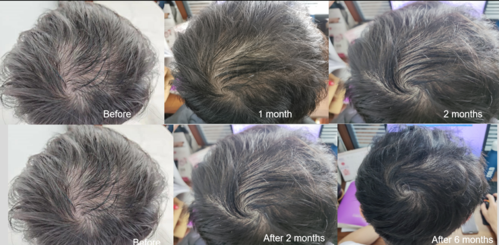 Laser Hair Growth Is The Gospel Of Baldness 1 图片1 3