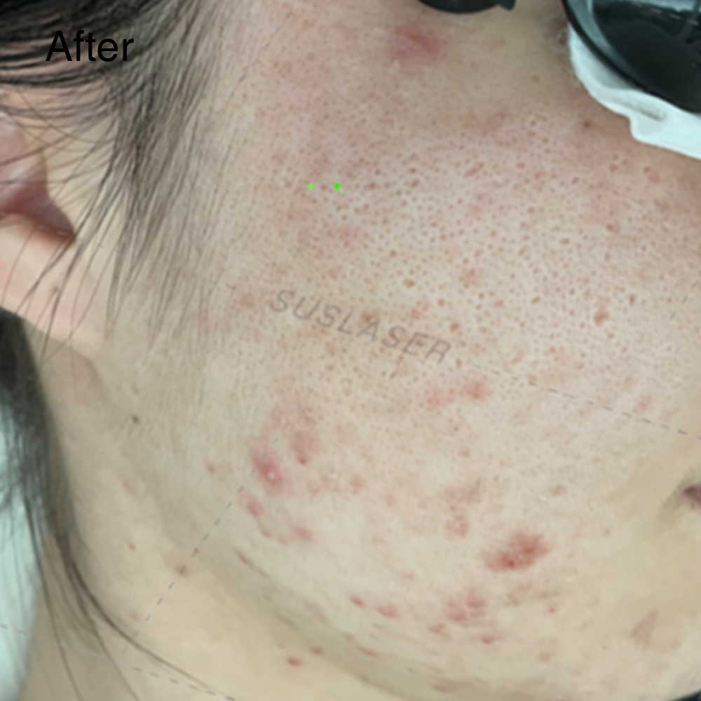 Don’t Let Acne Affect Your Beauty 1 正3 1