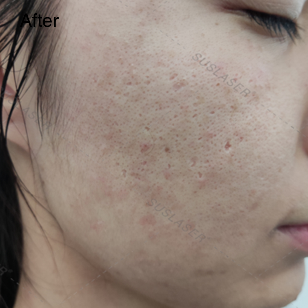 Don’t Let Acne Affect Your Beauty 7 正4