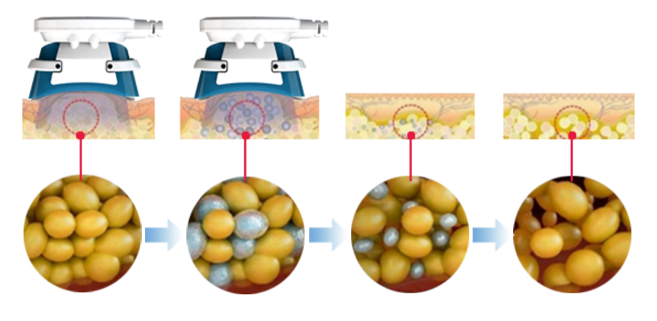 Cryolipolysis Kill The Fat Cells 1 Cryo 2